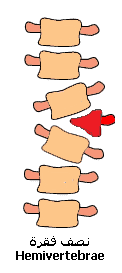 Scoliosis Scoliosis (9).gif